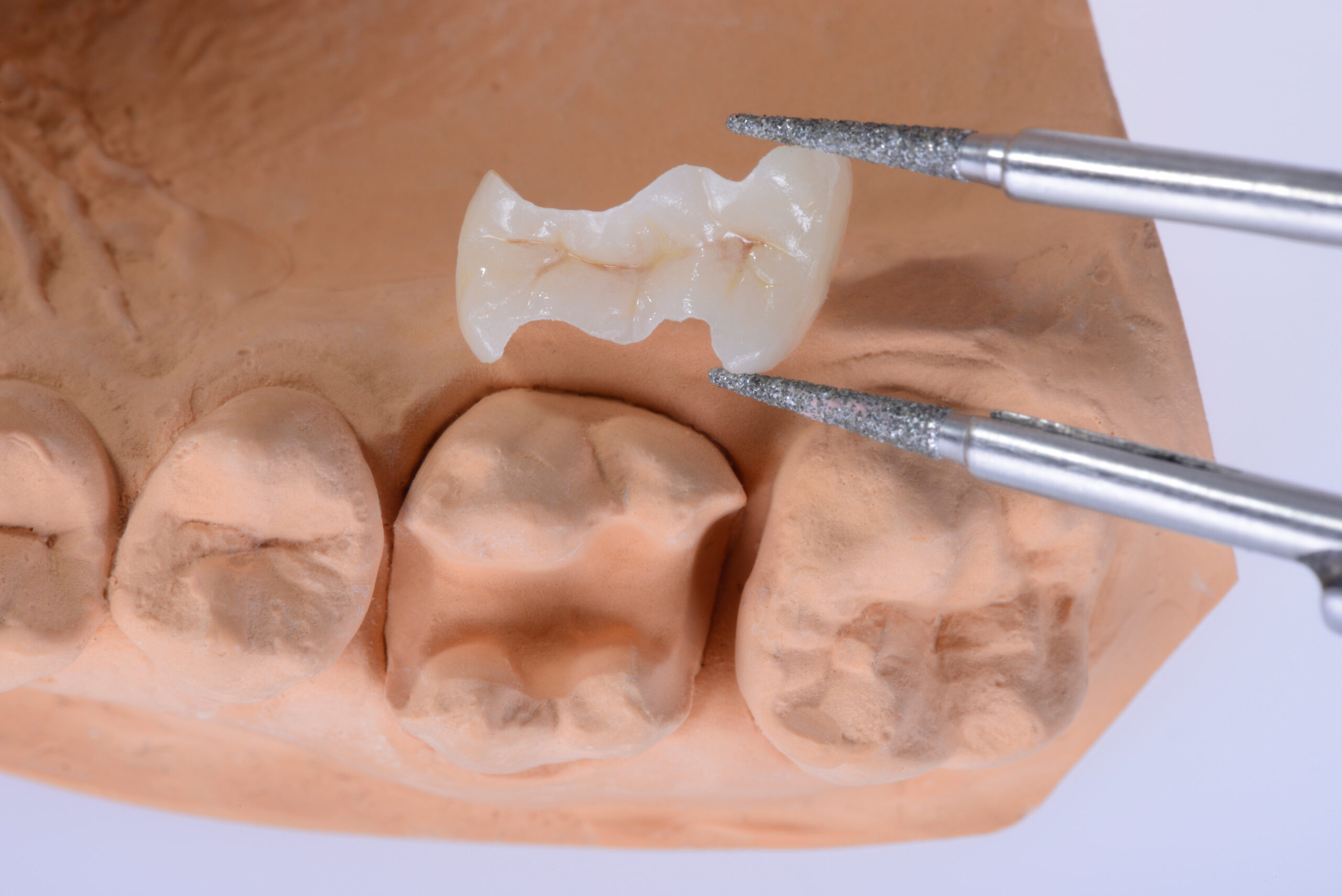 修復治療（歯の形態と機能を回復） | 江東区住吉駅前の歯医者「パル